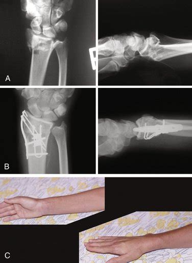 Fragment Specific Fixation Of Distal Radius Fractures Clinical Gate