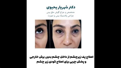 اصلاح پف و گودی زیر چشم Correction Of Puffiness And Dimples Under The