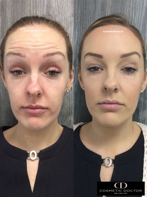 Anti Wrinkle Injections Photo Gallery Cosmetic Doctor Dublin