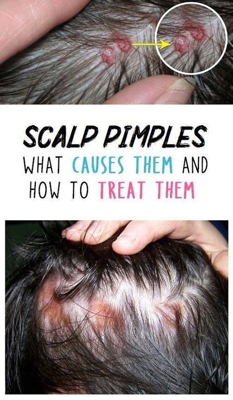 Scalp Pimples What Causes Them And How To Treat Them Pimplestreatment In 2020 Pimples On