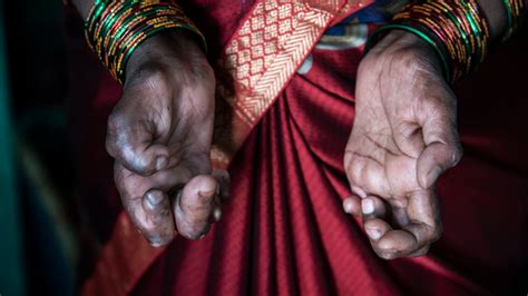 Leprosy Is Not Hereditary But Can Be Transferred - Health Practitioner