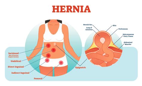 A hernia is the abnormal exit of tissue or an organ, such as the bowel, through the wall of the cavity in which it normally resides. Hernia - Orchard Health Clinic