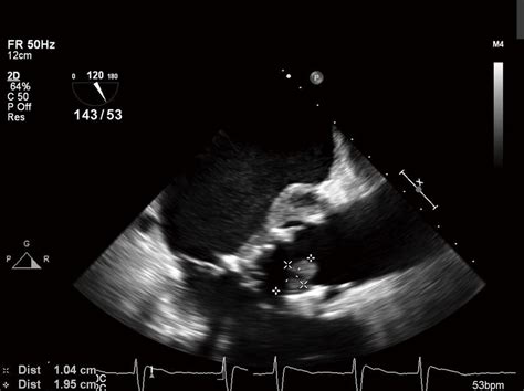 Transesophageal Echocardiography Tee Showing Vegetation On The Aortic