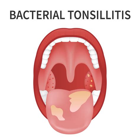 Bacterial And Viral Tonsillitis Angina Pharyngitis And Tonsillitis Tonsil Infection Open