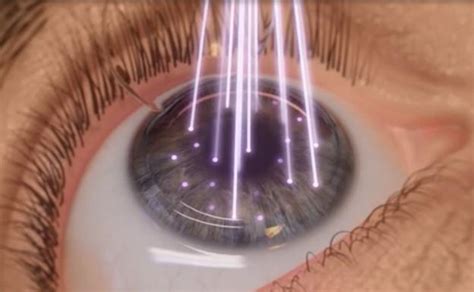 7 Venajes De La Cirugía Láser Ocular ¿por Qué Debes Hacértela Ideal