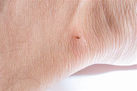 Sucking Tick Macro Photo On Human Skin Ixodes Ricinus Bloated