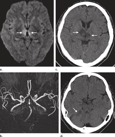 Basilar Artery Occlusion In A 61 Year Old Man With Ocular Signs And