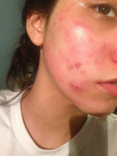 [Skin Concern] Am I having an allergic reaction? : SkincareAddiction