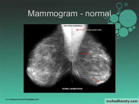 Mammogram Docx Mammogram Muhadharaty
