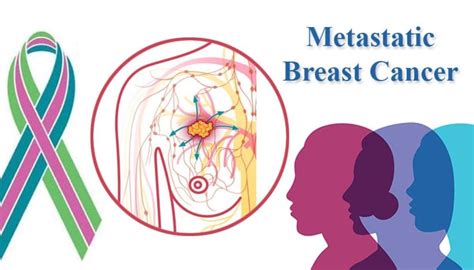 Advances In Metastatic Breast Cancer Positive Bioscience