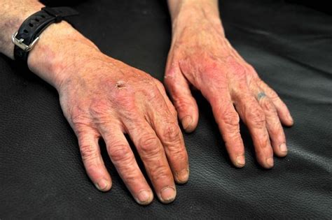 Womans Agony After Suffering 3rd Degree Burns To Hands After 30