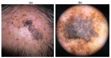 cancer bumps on scalp