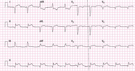 An Uncommon Electrocardiogram Cardiology Jama Internal Medicine