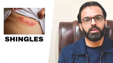 Shingles Causes Symptoms And Management Youtube