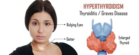 Common manifestations of thyroid disease in women include hypothyroidism, hyperthyroidism, and thyroid cancer. Hyperthyroidism in Women | Thyroid