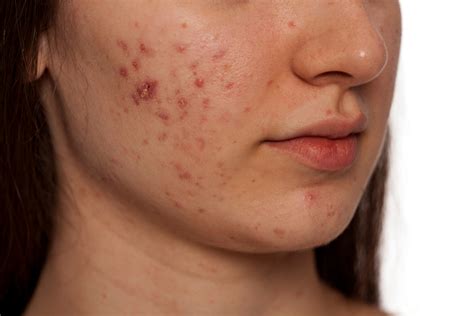 Remove Acne In A Week With The Use Of This Simple And Most Trusted