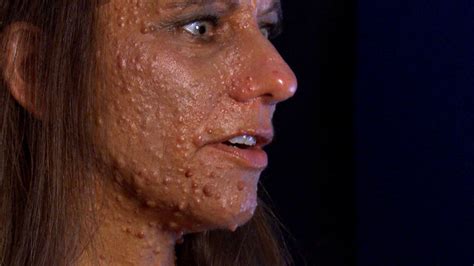 Hope For Woman With Entire Body Covered In Tumors The Doctors Tv Show