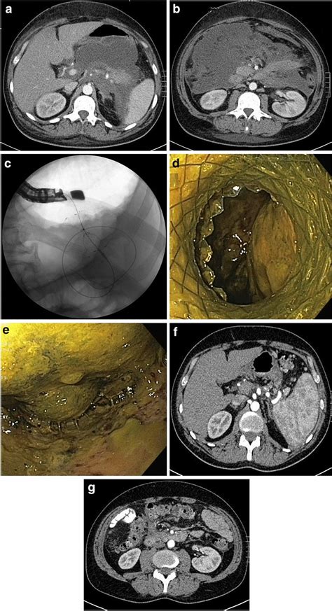 Ag Endoscopic Treatment Of Acute Necrotic Collections A Year Old