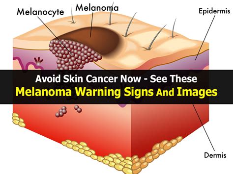 Melanoma is a kind of skin cancer that starts when skin cells called melanocytes grow out of control. Avoid Skin Cancer Now - See These Melanoma Warning Signs ...