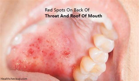 Red Painful Patch On Roof Of Mouth About Roof
