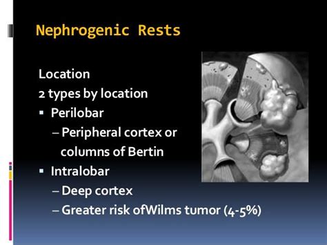 Nephrogenic Rests Location 2 Types By Location Perilobar Peripheral