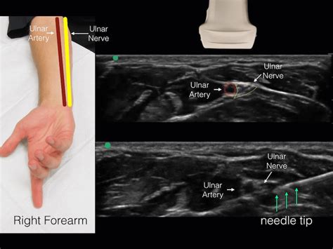 Trick Of The Trade Patient Positioning For Ultrasound Guided Ulnar