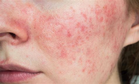 Rosacea Treatment By A Dermatologist Dermspecialists Ky