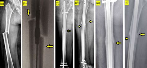 A Pre Operative Radiograph Showing Atypical Diaphyseal Femur Fracture