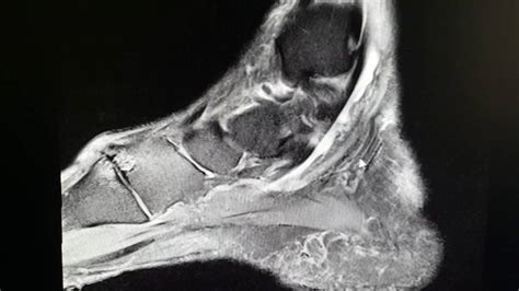 Flexor Hallucis Longus Tendon Rupture As Seen On MRI YouTube