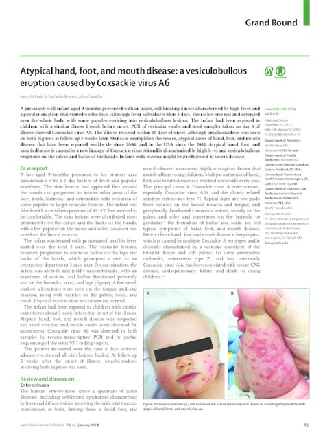 pdf atypical hand foot and mouth disease a vesiculobullous eruption caused by coxsackie