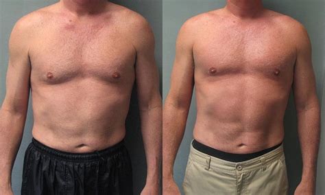 File55 Year Old Male With Moderate Gynecomastia Before And After