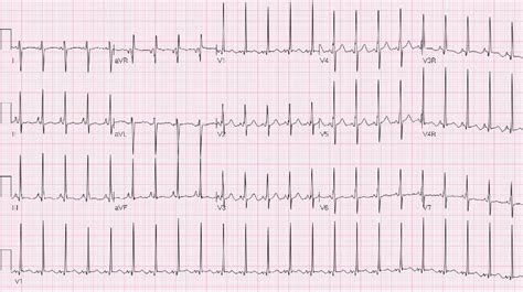 Defining The Electrocardiogram In The Neonate With Hypoplastic Left