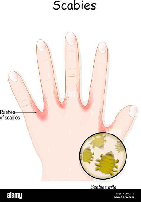 Scabies Mite Humans Hand Skin With Rashes Seven Year Itch Is A