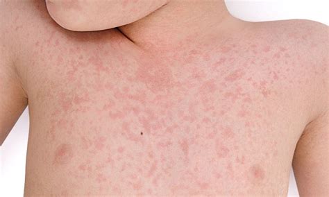 Sydneysiders Warned Of Measles After Infected Adults Visit