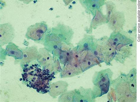 Figure 1 From Cannonballs In Pap Smears Double Whammy Of Bacterial
