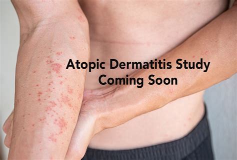 Atopic Dermatitis Clinical Trial Darst Dermatology Charlotte