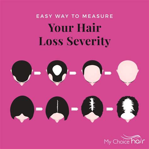 Heres An Easy Way To Measure Your Hair Loss Severity From The American Hair Loss Association