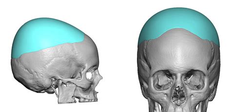 Plastic Surgery Case Study 2nd Stage Custom Skull Implant For Crown