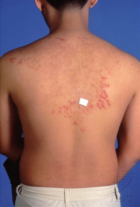 Erythematous Papules That Coalesce To Form A Reticulated Pattern And