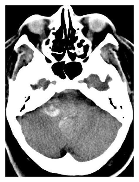 Axial A And Coronal B Noncontrast Computed Tomography Ct Of The