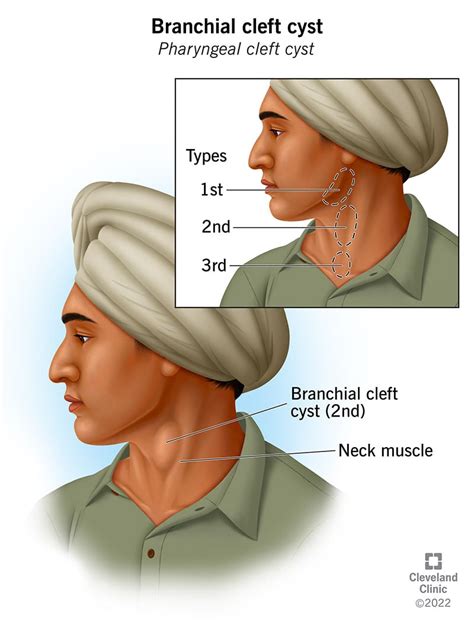 Branchial Cleft Cyst Radiology Surgery And Types