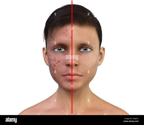 Acne Vulgaris On A Teenage Boys Face Computer Illustration Showing