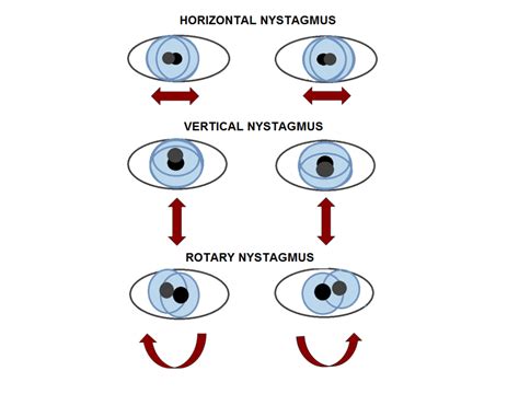 Eye And Vision Issues In Noonan Syndrome Noonan Syndrome Awareness