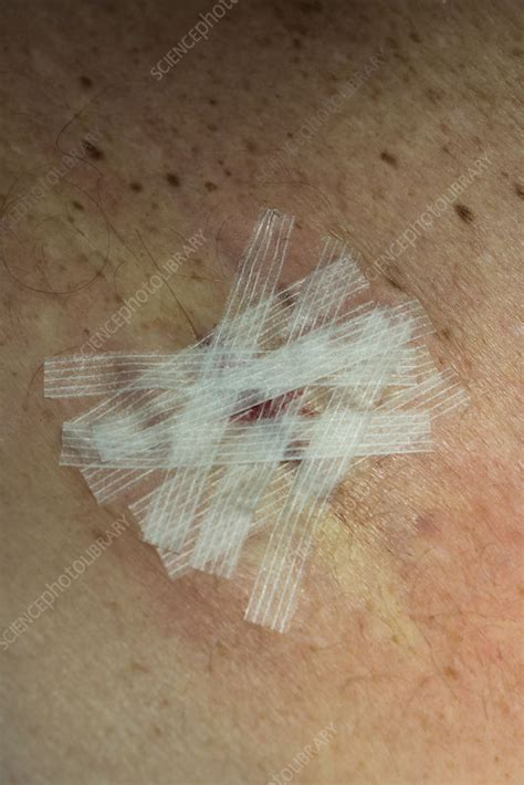 Scar After Melanoma Removal Stock Image C0478117 Science Photo