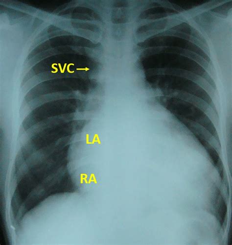 Cardiomegaly Due To Lv Dysfunction On X Ray Chest Pa View All About