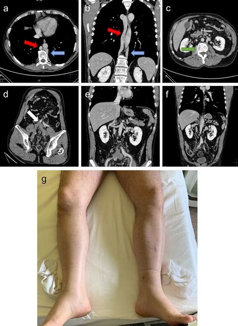 Axial And Coronal Contrast Enhanced Computerized Tomography Tc Scans