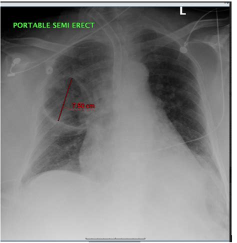 Cureus Rare But Fatal Case Of Cavitary Pneumonia Caused By