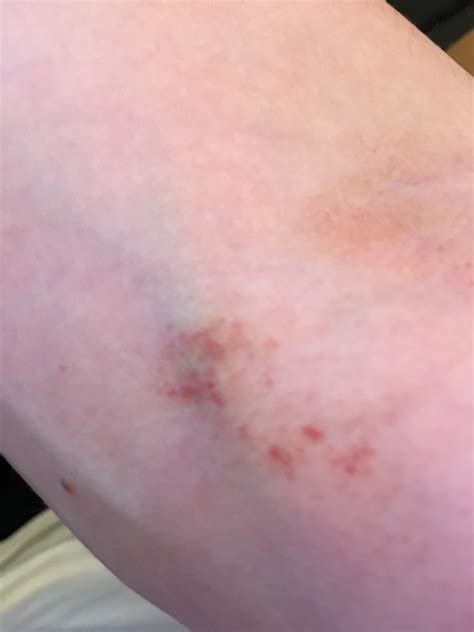 Maculeus).de term wordt in de dermatologie gebruikt voor een kleurverandering van de huid, zonder dat de huid verheven, ruw, ingezonken of anderszins veranderd is. Kleine rote Punkte auf der Haut , petechien? (Medizin ...