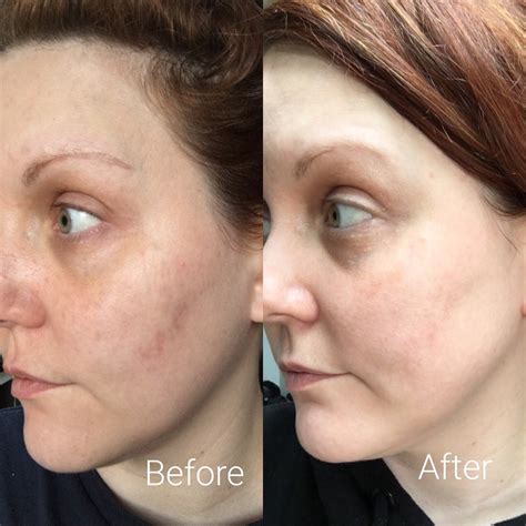 Vitamin c supplement for skin before and after. Timeless 20% Vitamin C Serum Review | PDXBEAUTIFUL