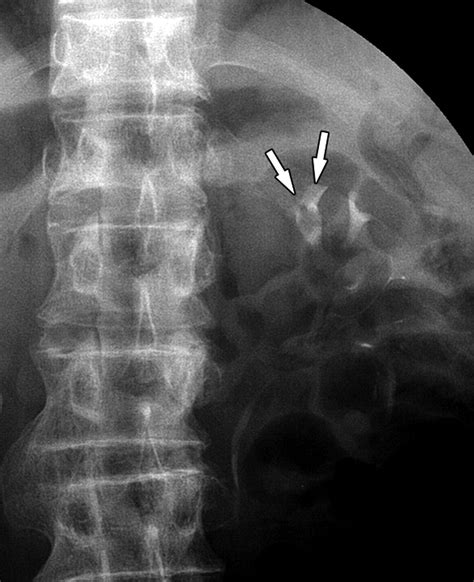 Renal Papillary Necrosis Review And Comparison Of Findings At Multi